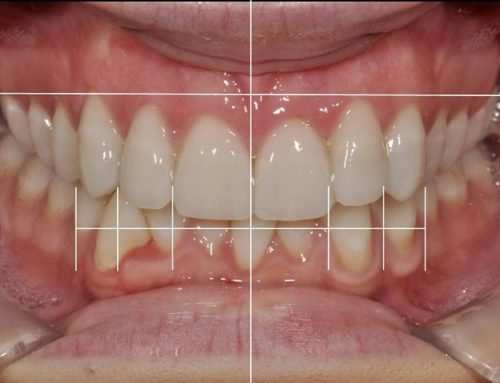 Highly Aesthetic Smile Makeover